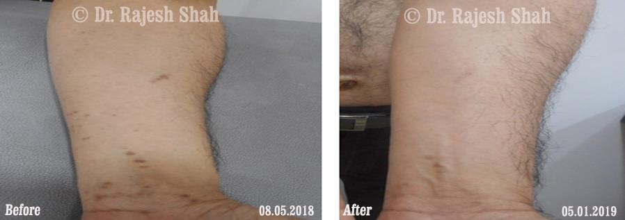 Lichen Planus Before and After Case Photo