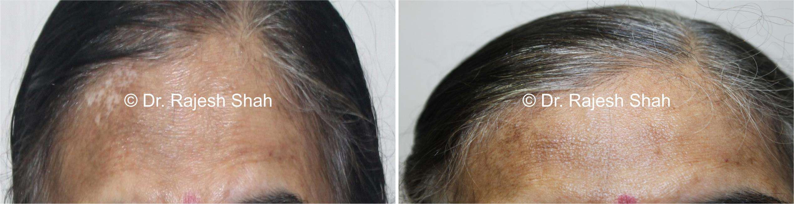 Vitiligo Before and After Case Photo