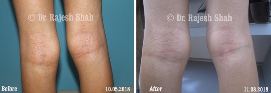 Eczema Before and After Case Photo