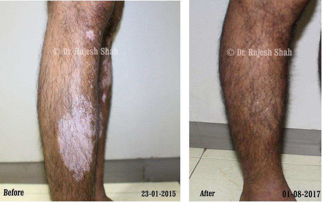 Vitiligo Before and After Case Photo
