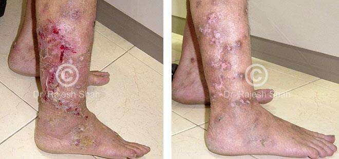 Lichen Planus Before and After Case Photo