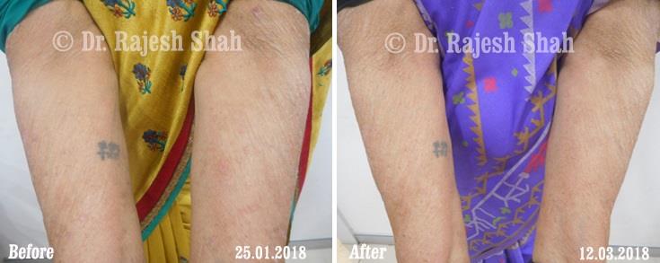 Psoriasis Before and After Case Photo