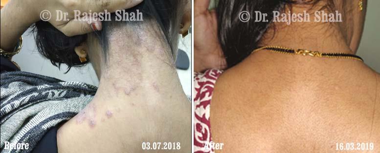 Psoriasis Before and After Case Photo