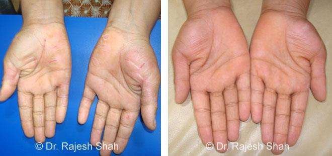 Psoriasis Before and After Case Photo