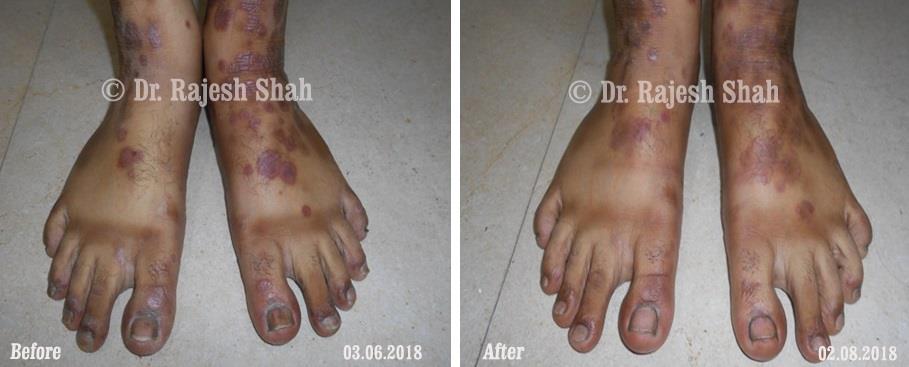 Psoriasis Before and After Case Photo