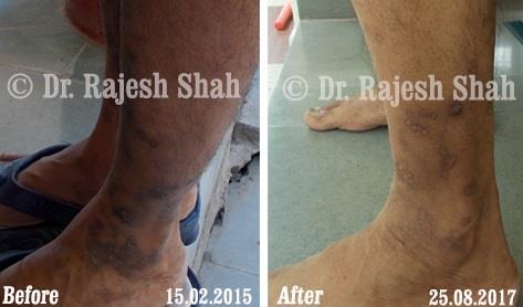 Lichen Planus Before and After Case Photo