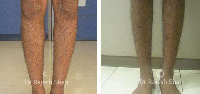 Lichen Planus Before and After Case Photo
