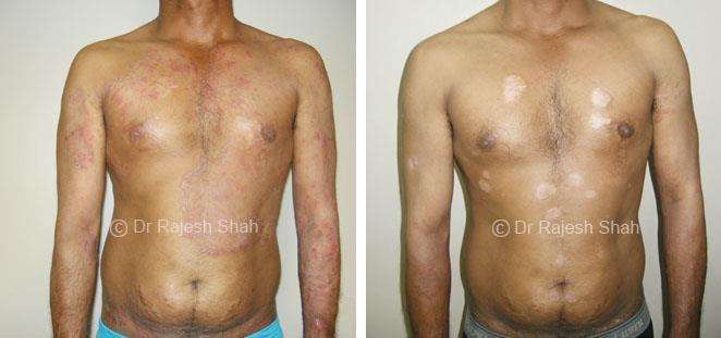 Psoriasis Before and After Case Photo