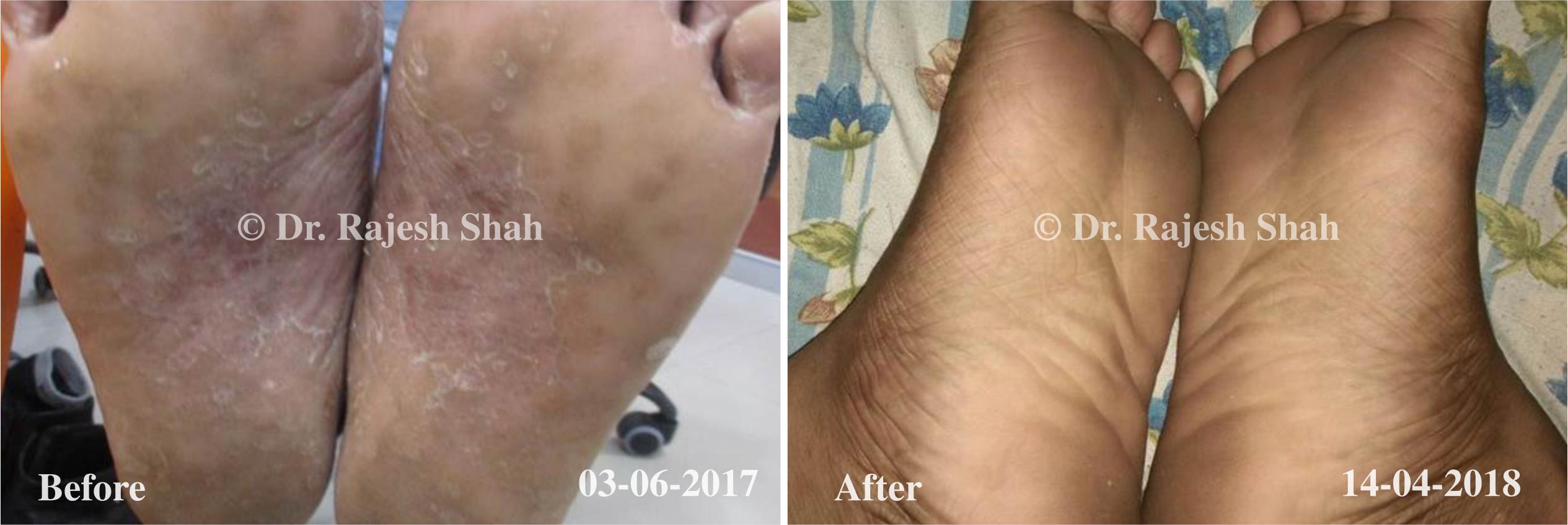 Psoriasis Before and After Case Photo