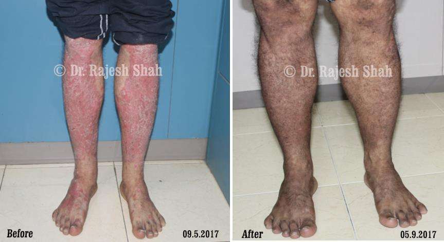 Psoriasis Before and After Case Photo