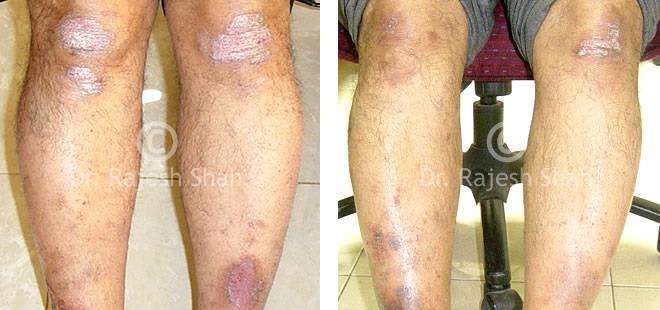 Psoriasis Before and After Case Photo