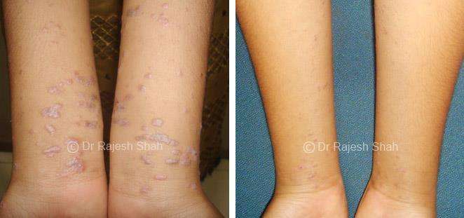 Lichen Planus Before and After Case Photo