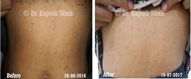 Lichen Planus Before and After Case Photo