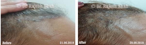 Psoriasis Before and After Case Photo