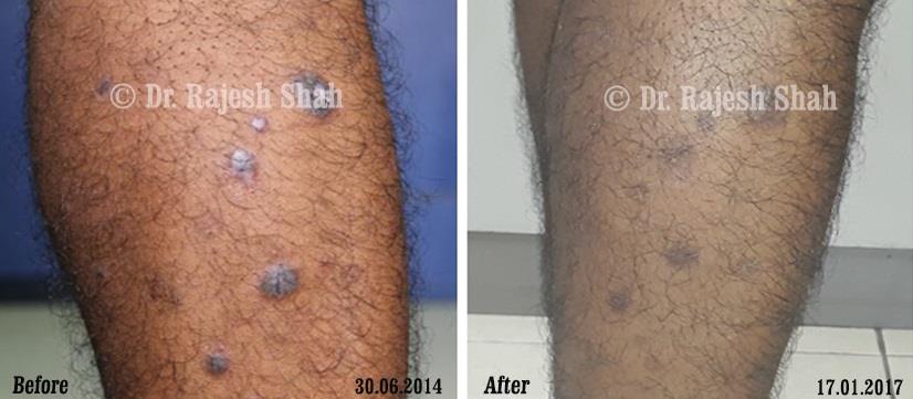 Lichen Planus Before and After Case Photo