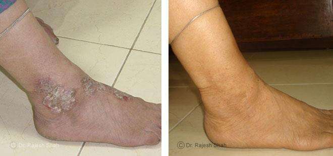 Eczema Before and After Case Photo