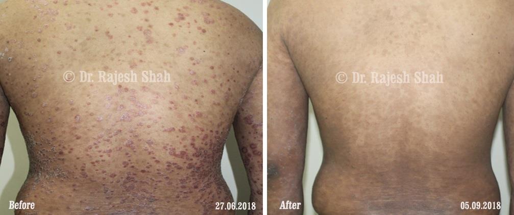 Psoriasis Before and After Case Photo