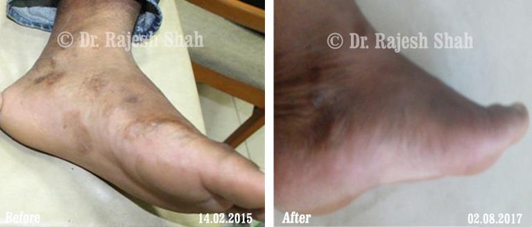 Psoriasis Before and After Case Photo