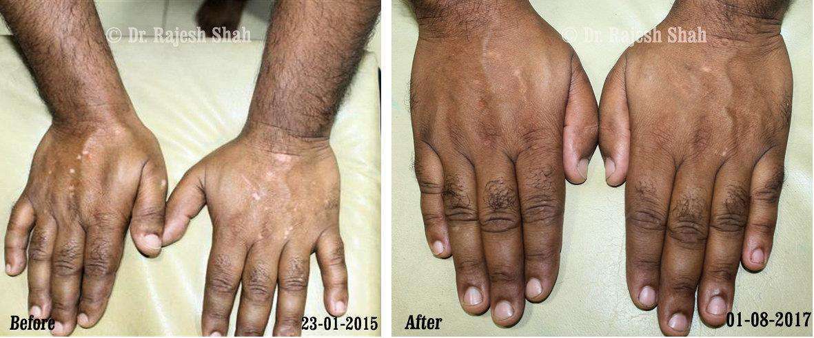 Vitiligo Before and After Case Photo