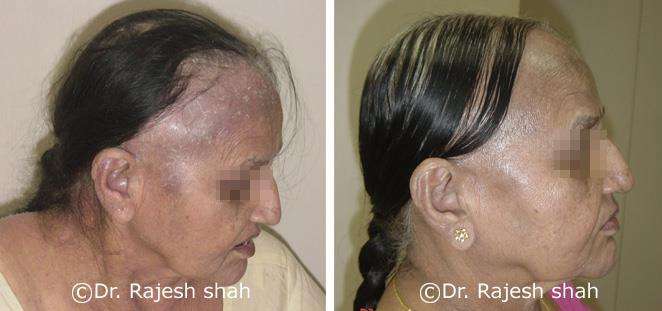 Psoriasis Before and After Case Photo