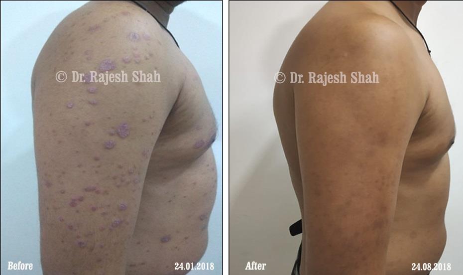 Psoriasis Before and After Case Photo