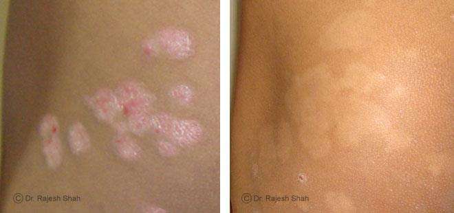 Psoriasis Before and After Case Photo