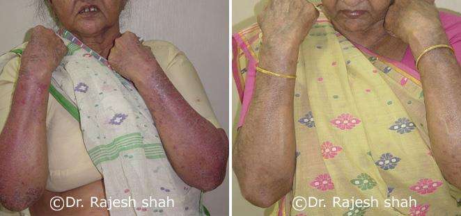 Psoriasis Before and After Case Photo