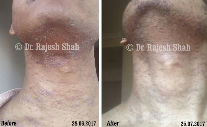 Psoriasis Before and After Case Photo