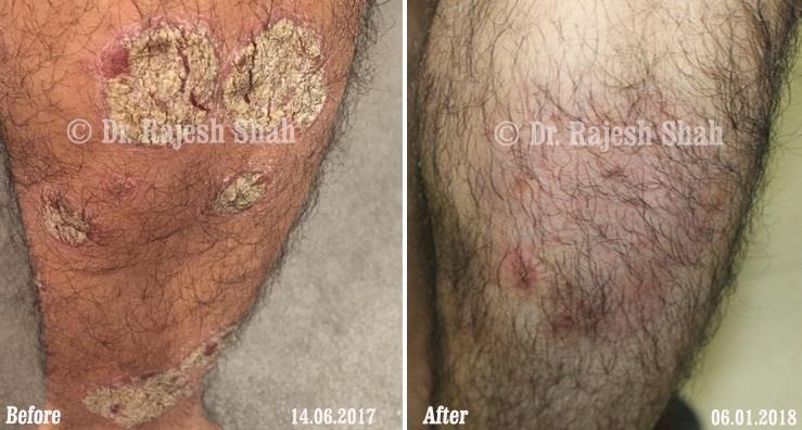 Psoriasis Before and After Case Photo