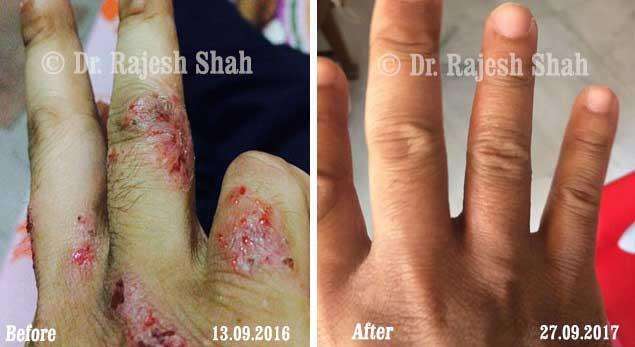 Atopic Dermatitis Before and After Case Photo