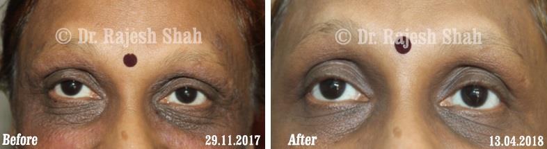 Eczema Before and After Case Photo