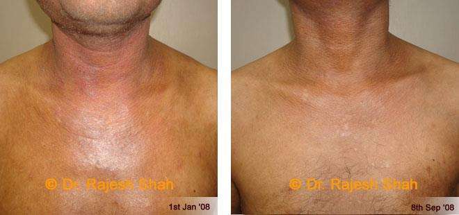 Eczema Before and After Case Photo