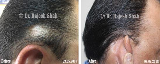 Alopecia Areata Before and After Case Photo