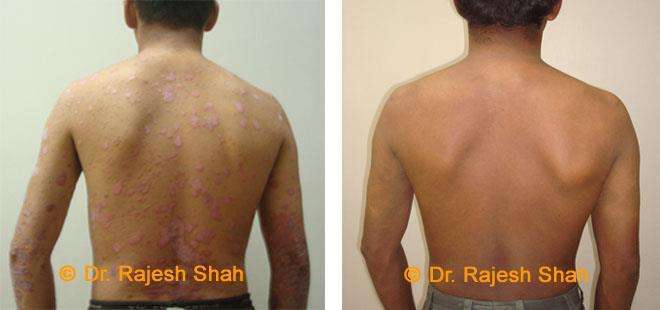 Psoriasis Before and After Case Photo
