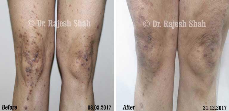 Lichen Planus Before and After Case Photo