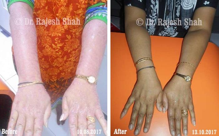 Psoriasis Before and After Case Photo