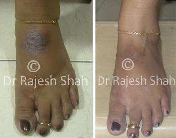 Eczema Before and After Case Photo