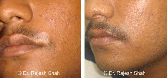 Vitiligo Before and After Case Photo