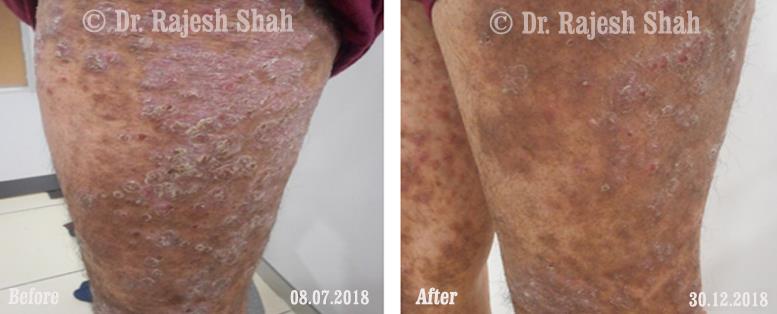 Psoriasis Before and After Case Photo