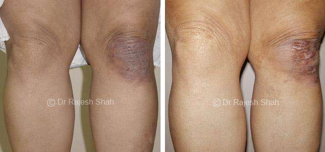 Psoriasis Before and After Case Photo