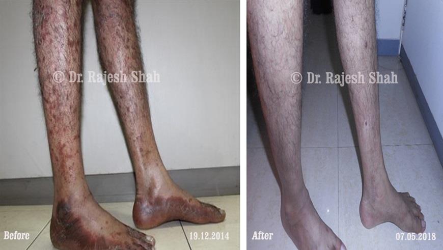 Psoriasis Before and After Case Photo