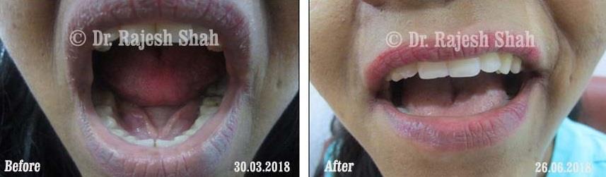 Cheilitis Before and After Case Photo
