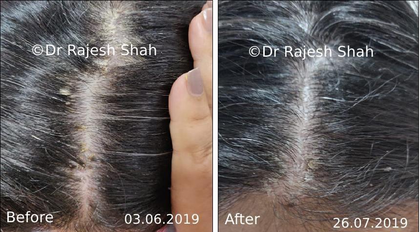 Psoriasis Before and After Case Photo