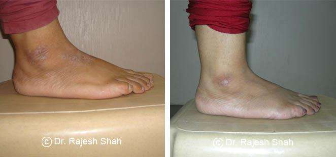 Psoriasis Before and After Case Photo