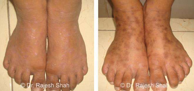 Lichen Planus Before and After Case Photo