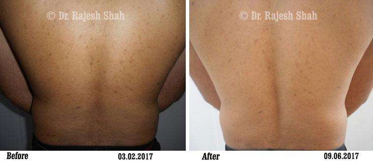 Lichen Planus Before and After Case Photo