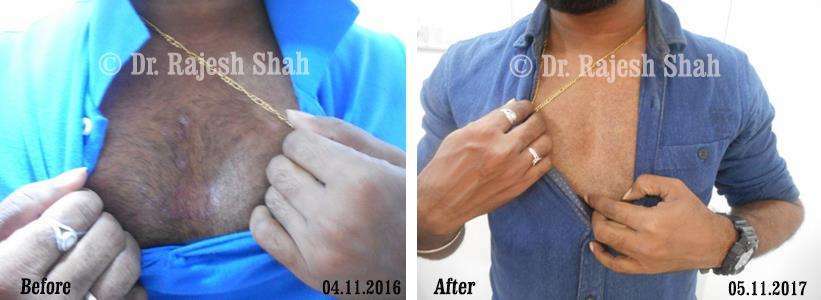 Psoriasis Before and After Case Photo