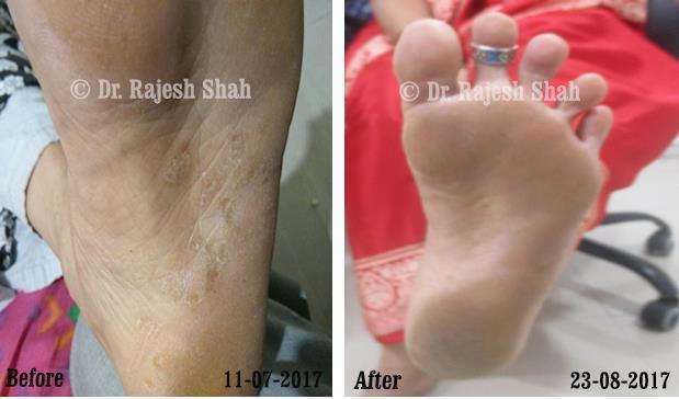 Psoriasis Before and After Case Photo