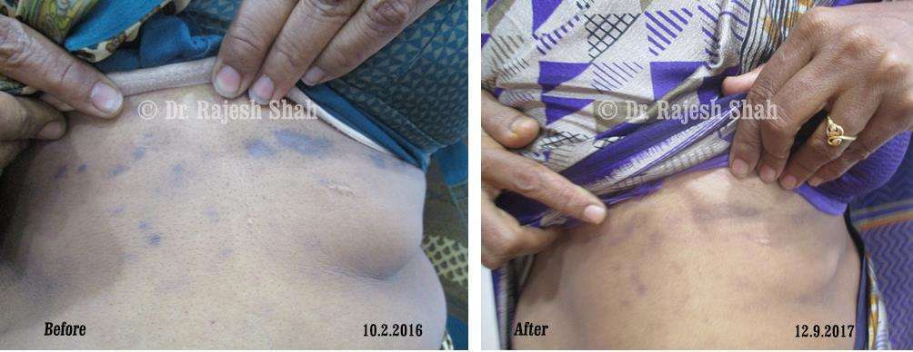 Hyperpigmentation Before and After Case Photo