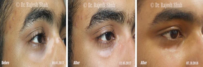 Vitiligo Before and After Case Photo
